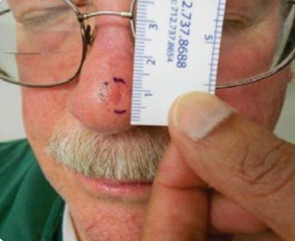 Basal cell carcinoma