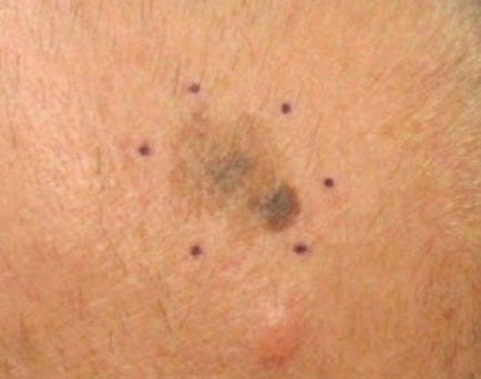 Melanoma