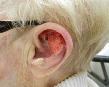 Squamous cell carcinoma